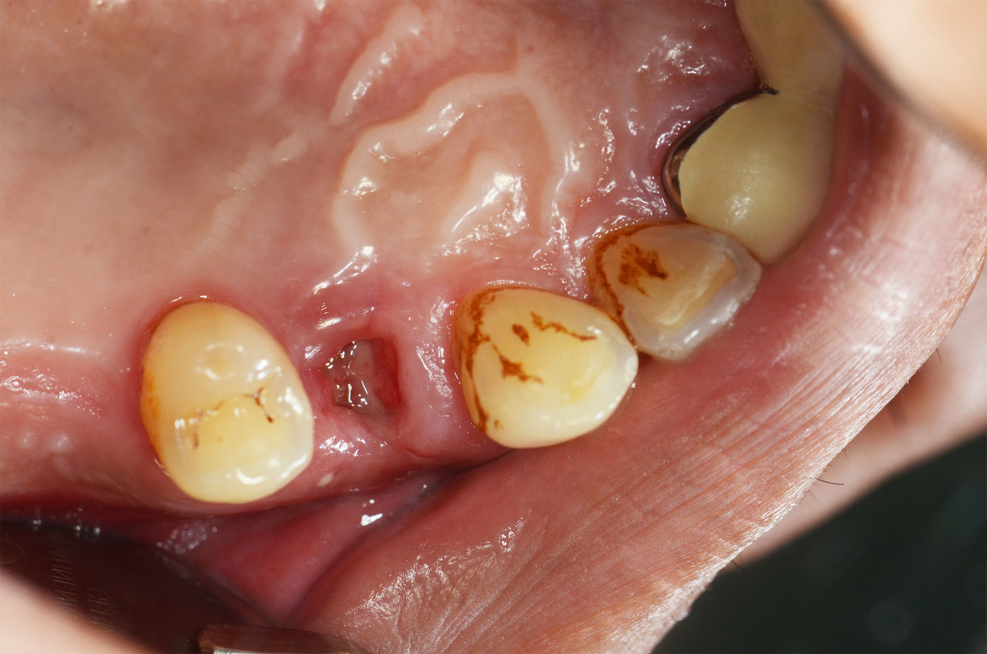 拔牙牙洞恢复过程图解,牙窝血凝块机化变白图 - 伤感说说吧