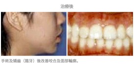 牙齒矯正配合手術-案例1-1