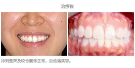 牙齒整齊排列-案例1-1