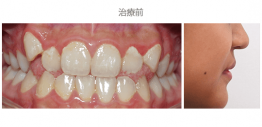 牙齒整齊排列-案例10