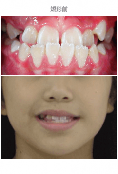 牙齒整齊排列-案例8