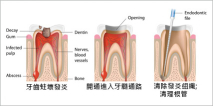 根管治療01