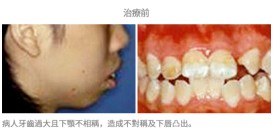 牙齒矯正配合手術-案例1