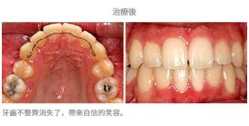 牙齒整齊排列-案例4-1