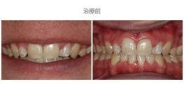 牙冠延長術-案例02