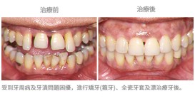 矯牙配合其他治療-案例1