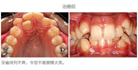 牙齒整齊排列-案例4